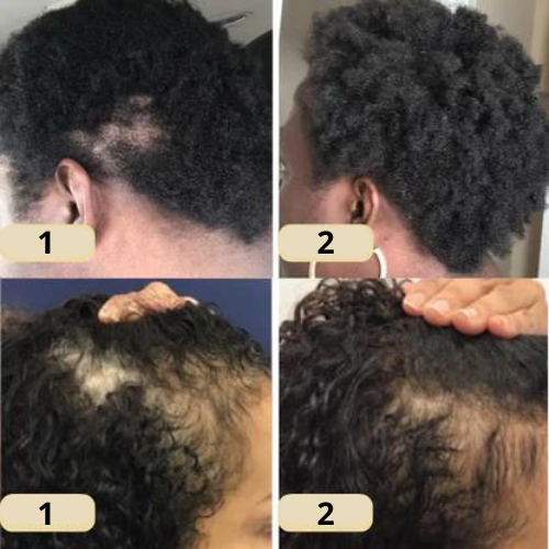 VitaTress™ — Ignite Your Scalp, Unleash Thick, Lush Hair That Commands Attention