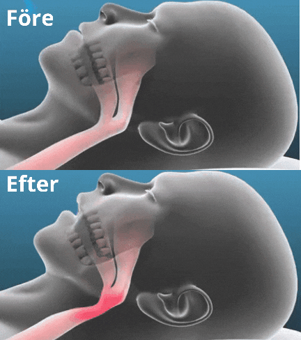 SomniEase™ — Silence Snoring, Unlock Energized Mornings and Deeper Connections