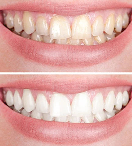 GlowPearl™ — Instantly Brighten Your Smile Without the Burn or Sensitivity