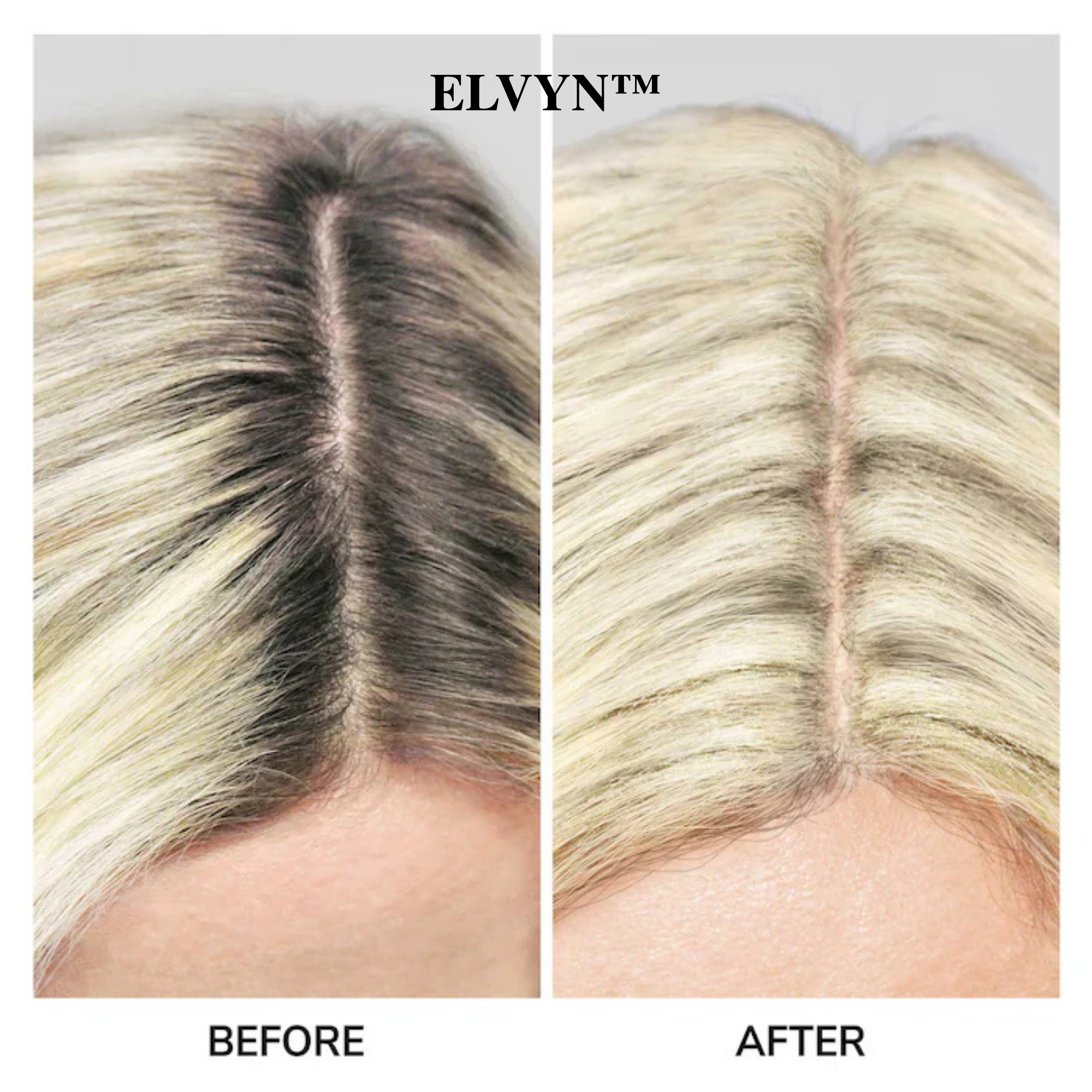 ShadeVeil™ — Instantly Reclaim a Fuller, Younger Hairline That Turns Heads Every Time