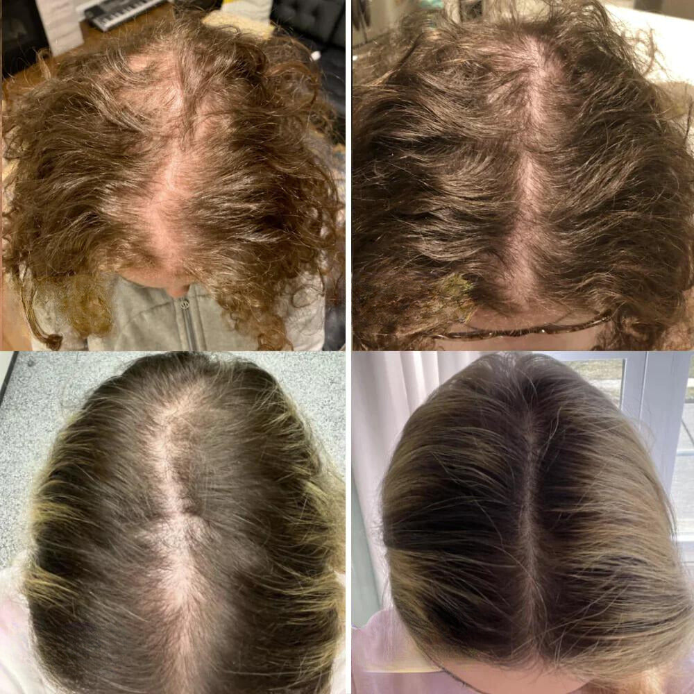 VitaTress™ — Ignite Your Scalp, Unleash Thick, Lush Hair That Commands Attention