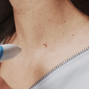 ClearSilq™ — Effortlessly Clear Skin That Boosts Your Confidence in Days