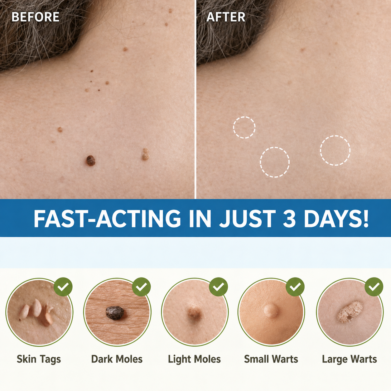 Skin Tag Removal Patches | Pain-Free Natural Formula | Multi-Patch Pack | Discreet Wear