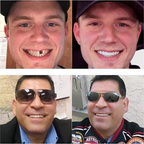 Snap-On Denture | Adjustable Fit | Natural-Looking Smile