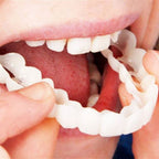 Snap-On Veneers | Flexible Fit Without Adhesive | Upper & Lower Set | Comfortable Fit