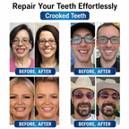Tooth Repair Kit for Adults | Moldable Denture Gel & LED Curing | Natural-Looking Repair