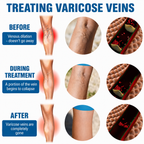 Varicose Vein Care Spray | Targeted Spray Application | Fast-Absorbing 30ml