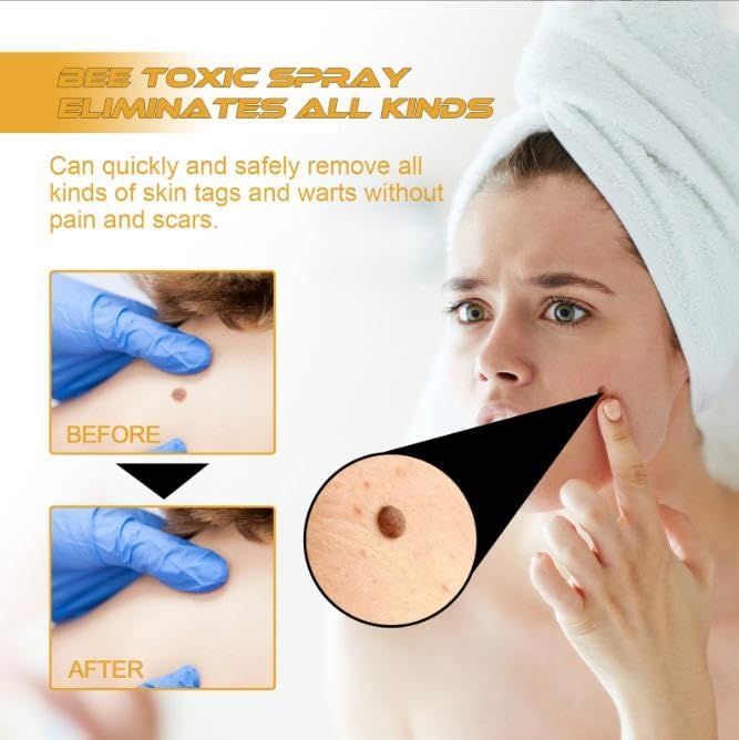 Wart Removal Spray | Targeted Bee Venom Formula | Scar-Free Healing