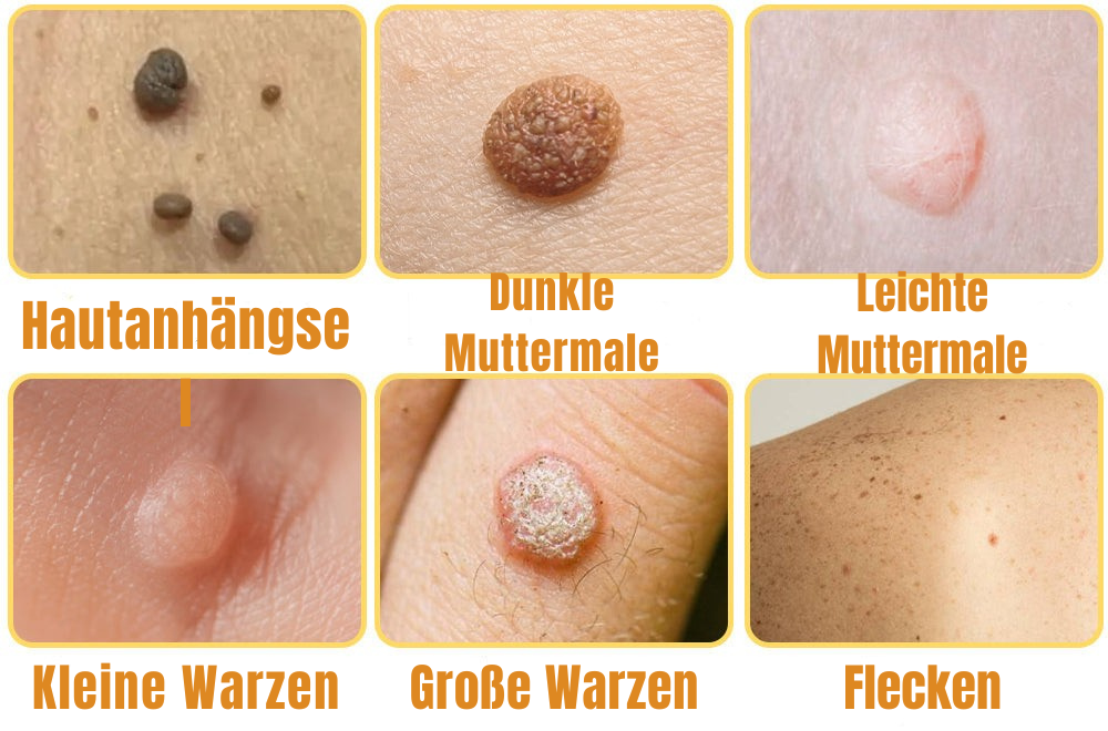 Wart Remover Spray | Bee Venom-Inspired Gentle Formula | 20ml | Pain-Free Application