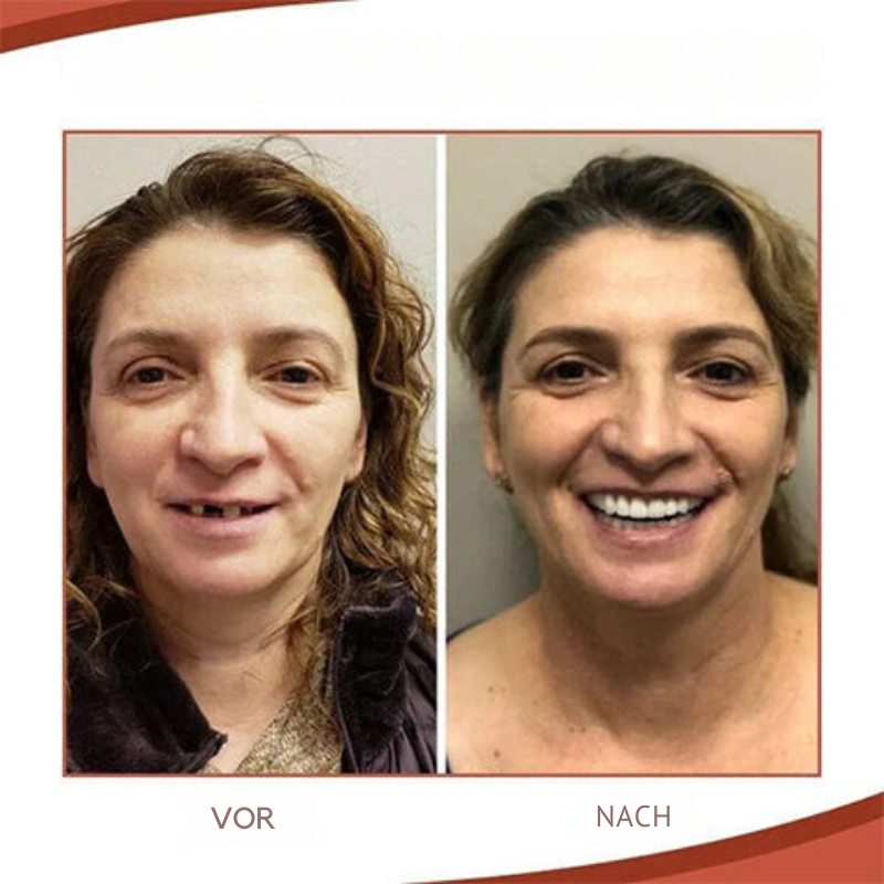Removable Dental Prosthetics | Soft Biocompatible Silicone | Upper & Lower Set | Comfortable Fit