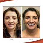 Removable Dental Prosthetics | Soft Biocompatible Silicone | Upper & Lower Set | Comfortable Fit