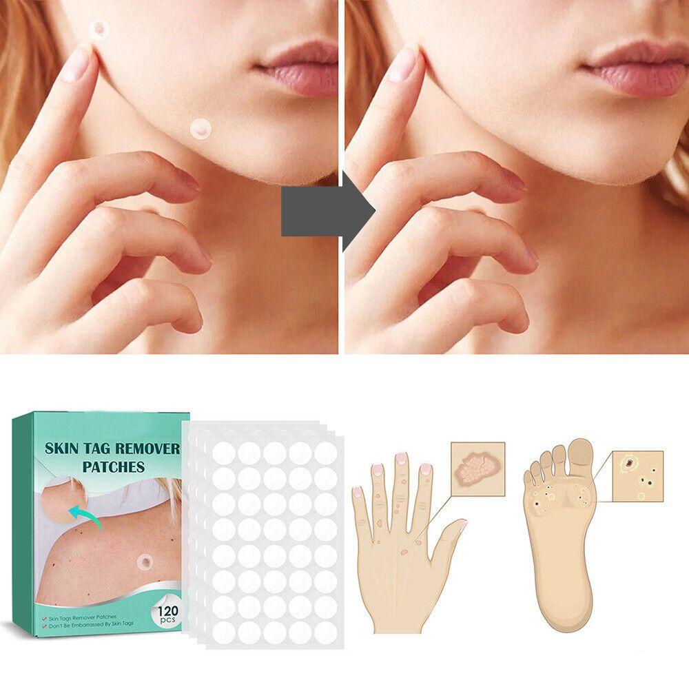 Skin Tag Patches | Hydrocolloid Plasters | 120 Count | Hypoallergenic Matte Finish