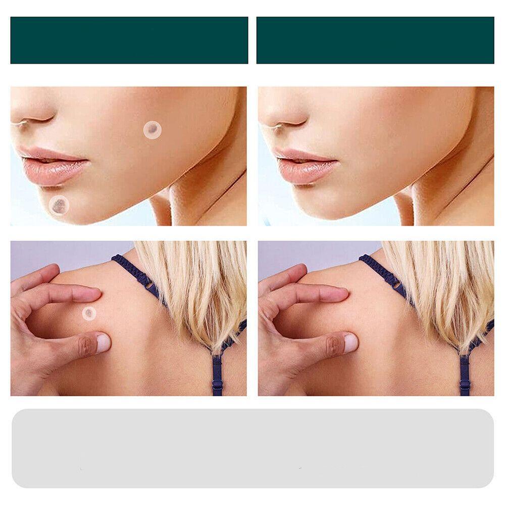 Skin Tag Patches | Hydrocolloid Plasters | 120 Count | Hypoallergenic Matte Finish