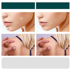 Skin Tag Patches | Hydrocolloid Plasters | 120 Count | Hypoallergenic Matte Finish