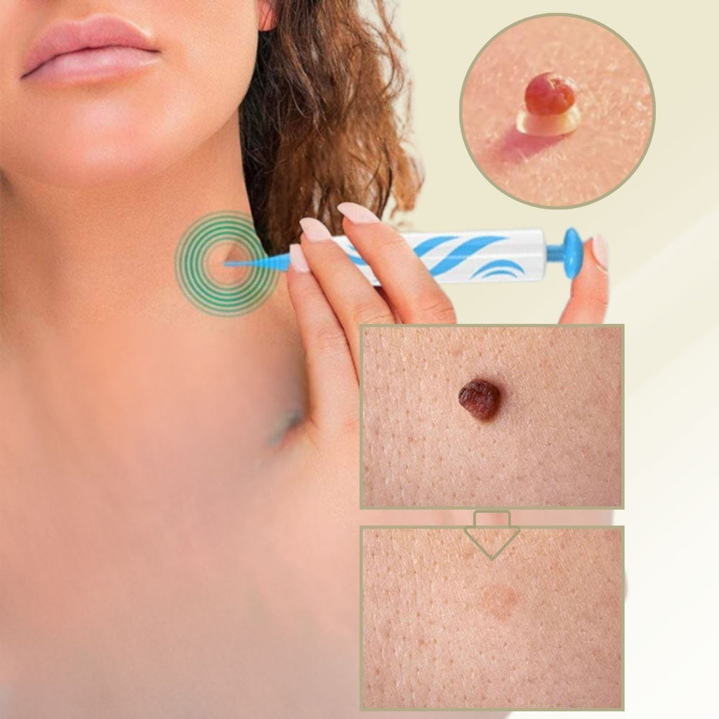 Wart & Mole Remover | Painless Non-Surgical Treatment | Skin-Friendly Formula | At-Home Use