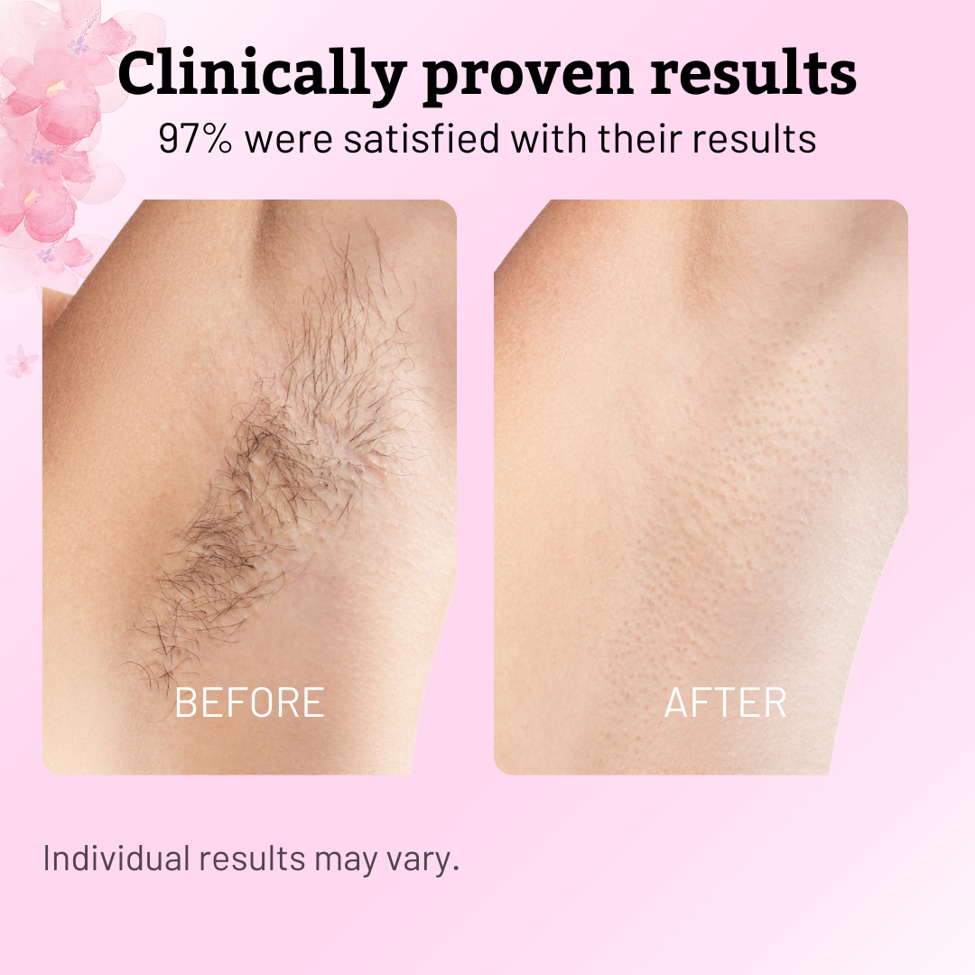 VeluDerm™ — Stop Hair Regrowth Fast and Enjoy Silky, Irritation-Free Skin Every Day