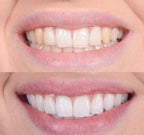 GlowWhiten | Teeth Whitener