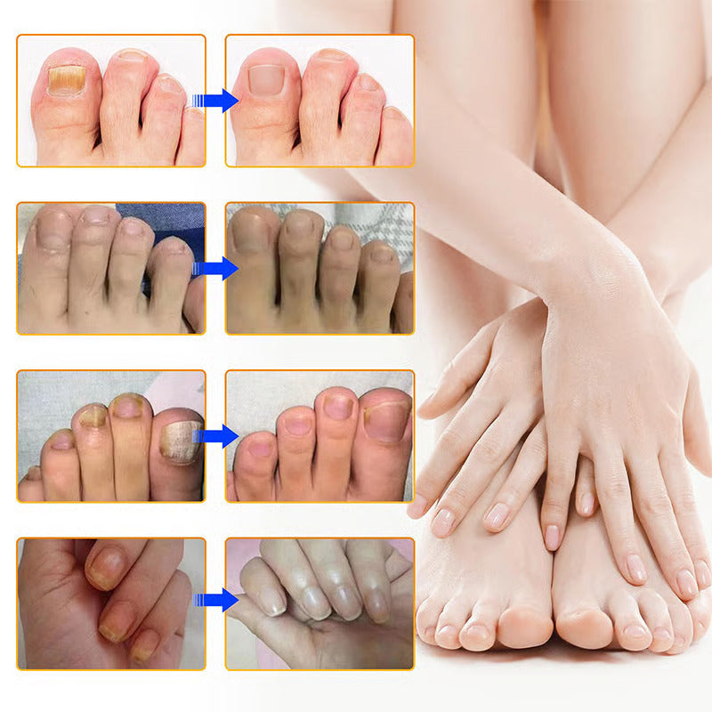 LumaDerm™ — Clear, Strong Nails That Let You Shine Without Shame