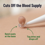 ClearEasePro™ — Band, Dry & Drop That Annoying Skin Tag in Under 2 Weeks